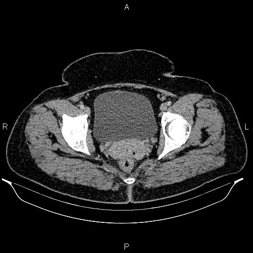 File:Bilateral ovarian dermoid cysts (Radiopaedia 85785-101603 A 100).jpg