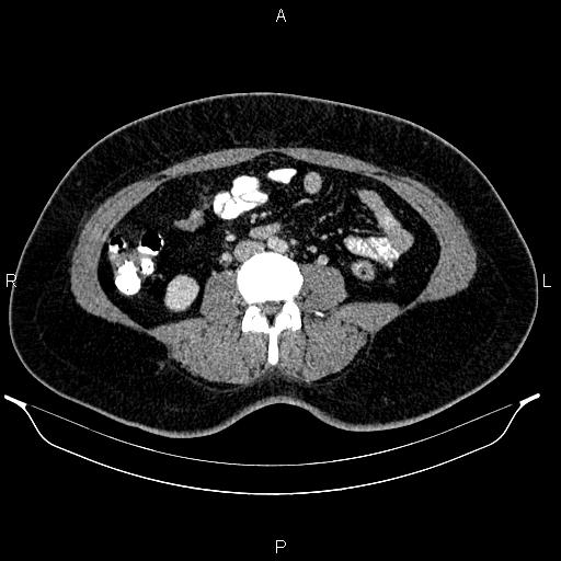 Bilateral ovarian dermoid cysts (Radiopaedia 85785-101603 A 61).jpg
