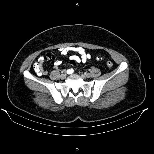 Bilateral ovarian dermoid cysts (Radiopaedia 85785-101603 A 79).jpg