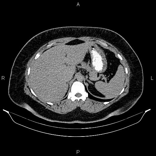 Bilateral ovarian dermoid cysts (Radiopaedia 85785-101603 Axial C+ delayed 12).jpg
