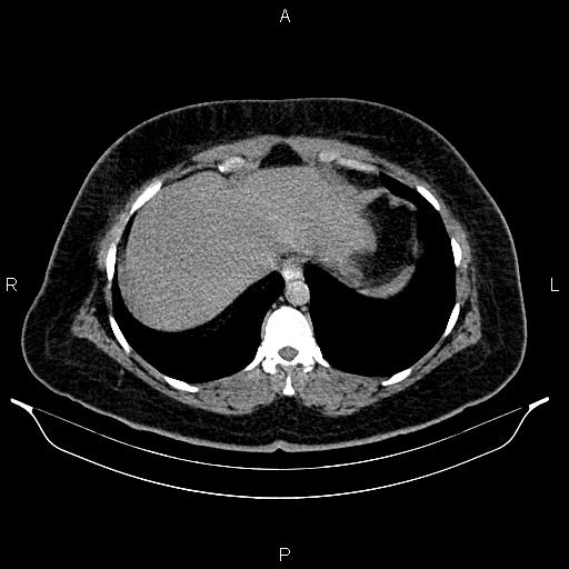 Bilateral ovarian dermoid cysts (Radiopaedia 85785-101603 Axial C+ delayed 3).jpg