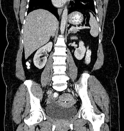 Bilateral ovarian dermoid cysts (Radiopaedia 85785-101603 C 34).jpg