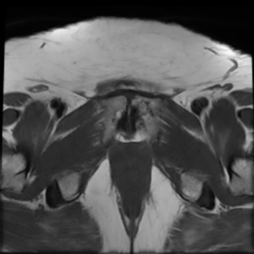 File:Bilateral ovarian dermoid cysts (Radiopaedia 90152-107338 Axial T1 21).jpg