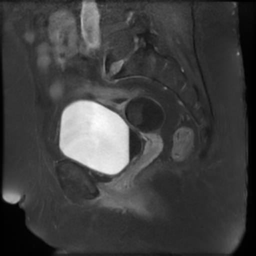 File:Bilateral ovarian dermoid cysts (Radiopaedia 90152-107338 Sagittal T1 C+ 10).jpg