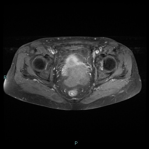 File:Bilateral ovarian fibroma (Radiopaedia 44568-48293 Axial T1 C+ fat sat 19).jpg
