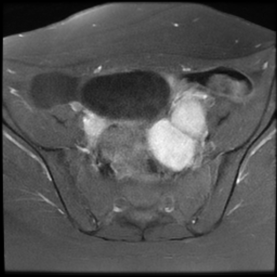 File:Bilateral ovarian fibrothecomas - adolescent (Radiopaedia 86604-102707 Axial T1 C+ fat sat 11).jpg