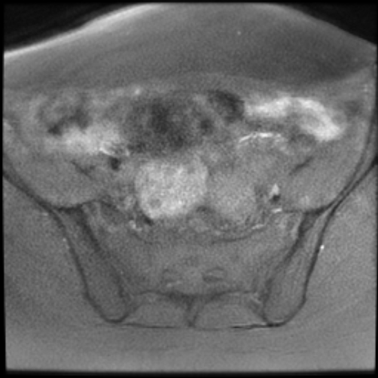File:Bilateral ovarian fibrothecomas - adolescent (Radiopaedia 86604-102707 Axial T1 fat sat 10).jpg
