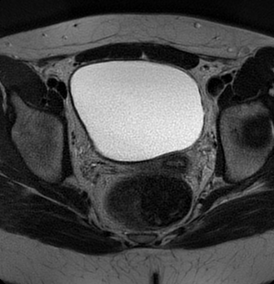 File:Bilateral ovarian fibrothecomas - adolescent (Radiopaedia 86604-102707 Axial T2 29).jpg