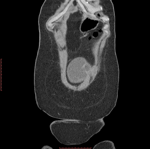File:Bilateral ovarian serous cystadenocarcinoma with right ovarian torsion (Radiopaedia 32640-33611 B 2).jpg