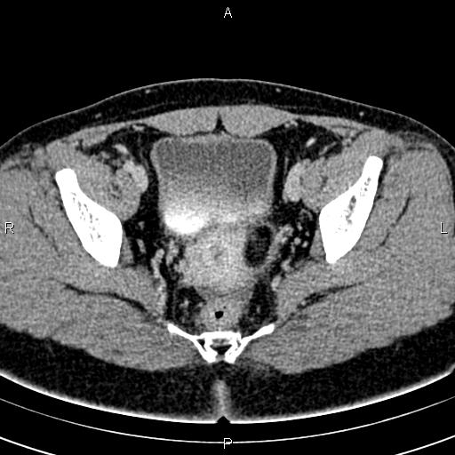 Bilateral ovarian teratoma (Radiopaedia 83131-97503 B 50).jpg