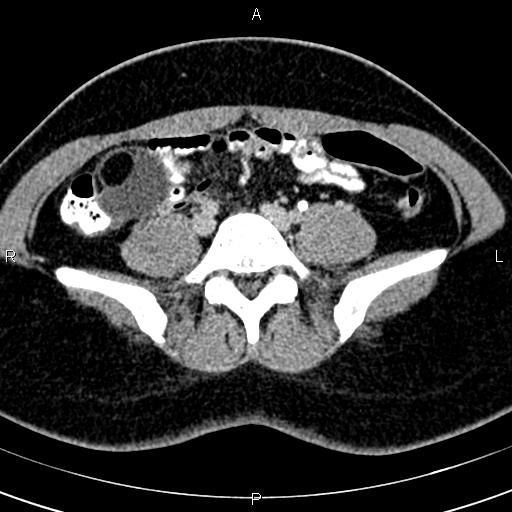 Bilateral ovarian teratoma (Radiopaedia 83131-97503 B 8).jpg
