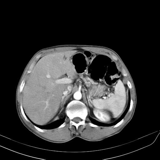 Bilateral parotid gland lymphoma (Radiopaedia 21038-20969 A 53).jpg