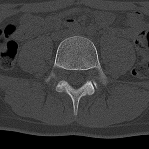 Bilateral pars defect (Radiopaedia 26691-26846 Axial bone window 33).jpg