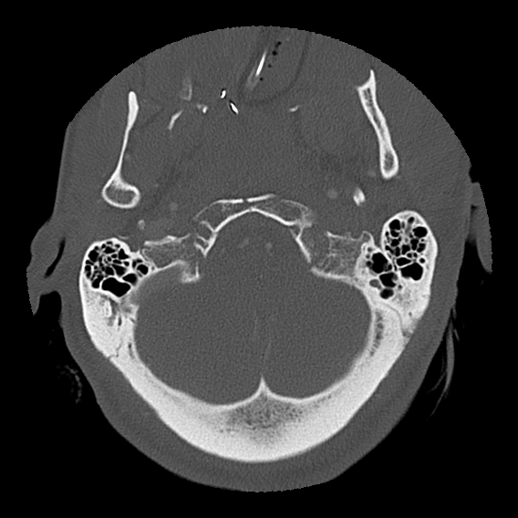 File:Bilateral perched facets with cord injury (Radiopaedia 45587-49713 Axial bone window 17).jpg
