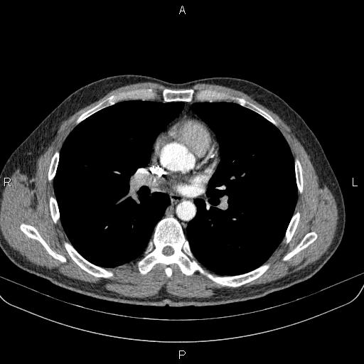 File:Bilateral pulmonary AVM (Radiopaedia 83134-97505 A 37).jpg