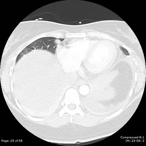 Bilateral pulmonary emboli with Hampton hump sign (Radiopaedia 54070-60246 Axial lung window 25).jpg