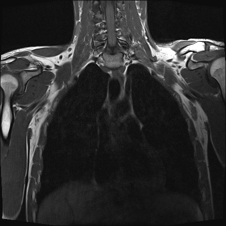 File:Bilateral spinoglenoid notch ganglion cysts (Radiopaedia 29577-30082 Coronal T1 14).jpg
