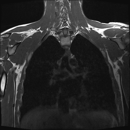 File:Bilateral spinoglenoid notch ganglion cysts (Radiopaedia 29577-30082 Coronal T1 18).jpg