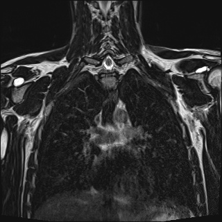 Bilateral spinoglenoid notch ganglion cysts (Radiopaedia 29577-30082 Coronal T2 69).jpg
