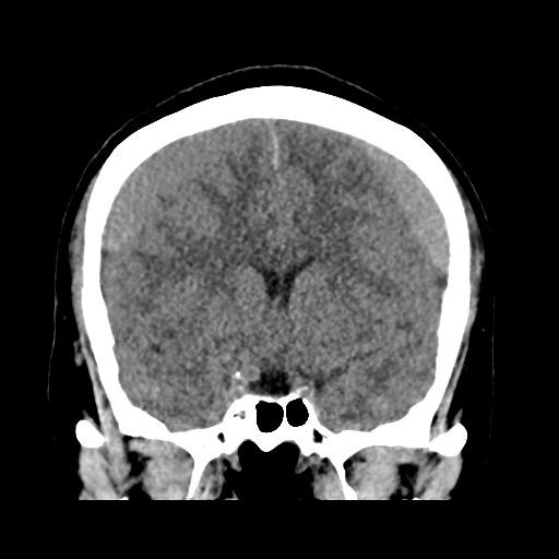 Bilateral subacute subdural hematoma (Radiopaedia 69240-79018 Coronal non-contrast 23).jpg