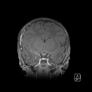 Bilateral subdural hemorrhage and parietal skull fracture (Radiopaedia 26058-26190 Coronal T1 21).png