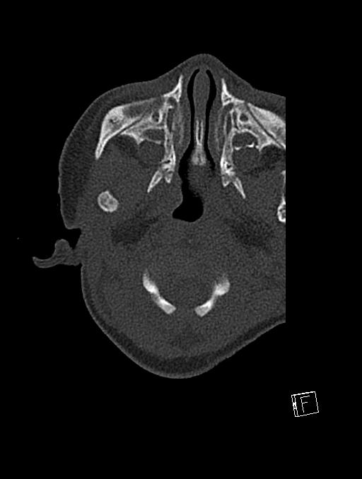 Bilateral subdural hemorrhage and parietal skull fracture (Radiopaedia 26058-26192 Axial bone window 122).png