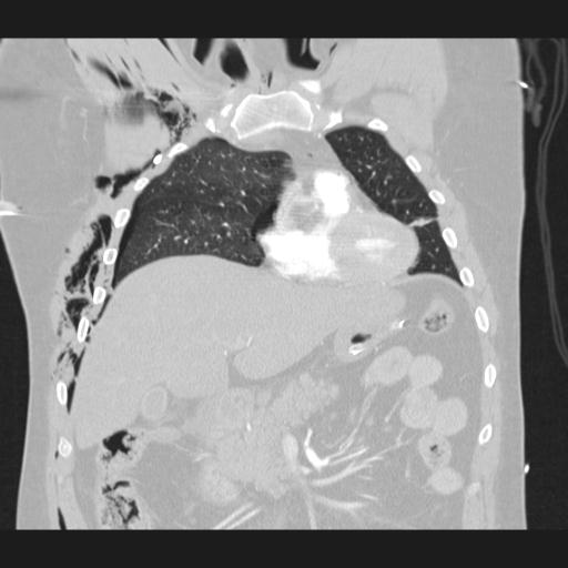 Bilateral traumatic renovascular injury (Radiopaedia 32051-32995 Coronal lung window 27).jpg