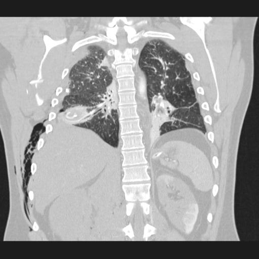 Bilateral traumatic renovascular injury (Radiopaedia 32051-32995 Coronal lung window 57).jpg