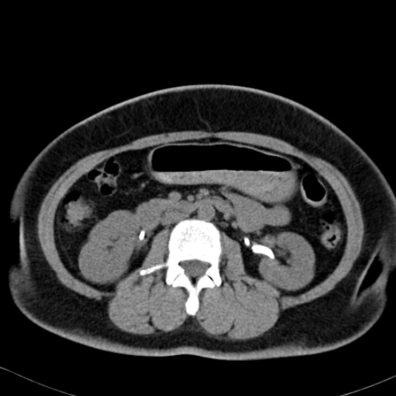 Bilateral ureteric stents (Radiopaedia 48795-53825 Axial non-contrast 26).jpg
