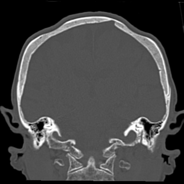 Biparietal osteodystrophy (Radiopaedia 46109-50463 Coronal bone window 64).jpg
