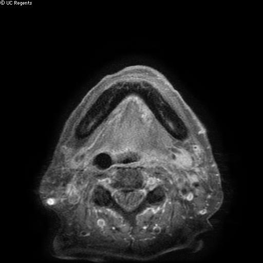 Bisphosphonate-related osteonecrosis of the maxilla (Radiopaedia 51367-57101 Axial T1 C+ fat sat 2).jpg