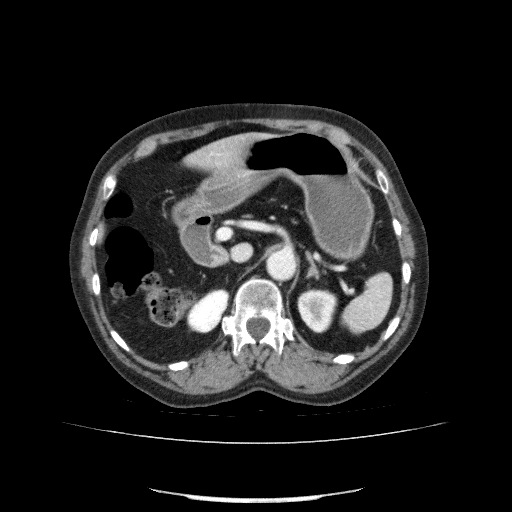 File:Bladder tumor detected on trauma CT (Radiopaedia 51809-57609 B 41).jpg