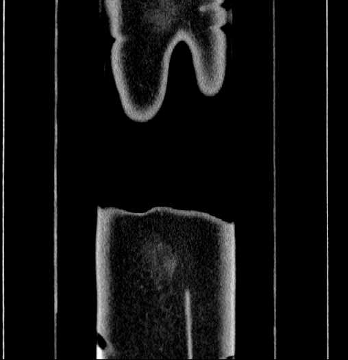 File:Blind-ending branch of a bifid ureter (Radiopaedia 61159-69048 F 72).jpg