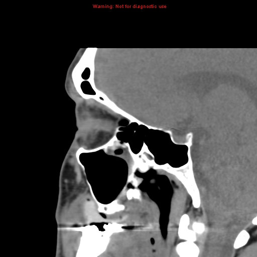 File:Blowout fracture with inferior rectus entrapment (Radiopaedia 12418-12673 C 15).jpg