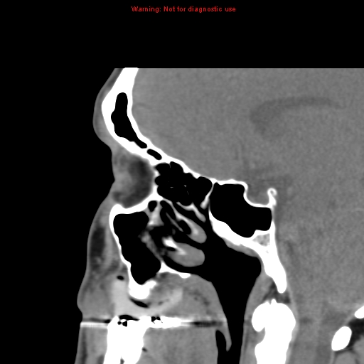 File:Blowout fracture with inferior rectus entrapment (Radiopaedia 12418-12673 C 17).jpg