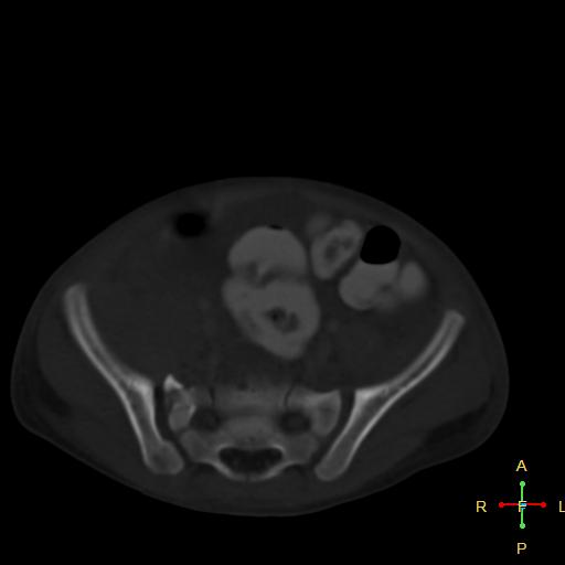 File:Blunt abdominal trauma (Radiopaedia 24780-25044 Axial bone window 9).jpg