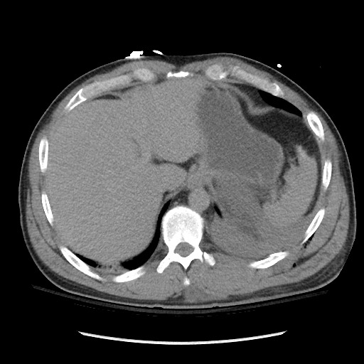 Blunt abdominal trauma with solid organ and musculoskelatal injury with active extravasation (Radiopaedia 68364-77895 Axial C+ delayed 26).jpg