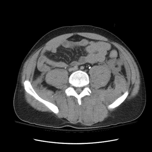 Blunt abdominal trauma with solid organ and musculoskelatal injury with active extravasation (Radiopaedia 68364-77895 Axial C+ delayed 91).jpg