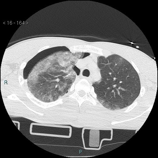 Blunt chest trauma (Swiss cheese sign) (Radiopaedia 38519-40618 Axial lung window 18).jpg