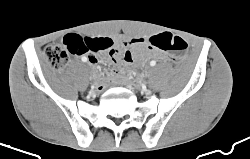 Blunt injury to the small bowel (Radiopaedia 74953-85987 A 146).jpg