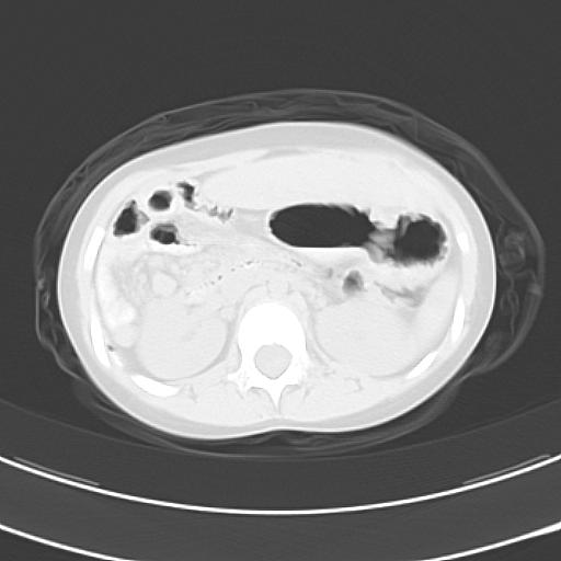 File:Bochdalek diaphragmatic hernia (Radiopaedia 38866-41059 Axial lung window 28).jpg