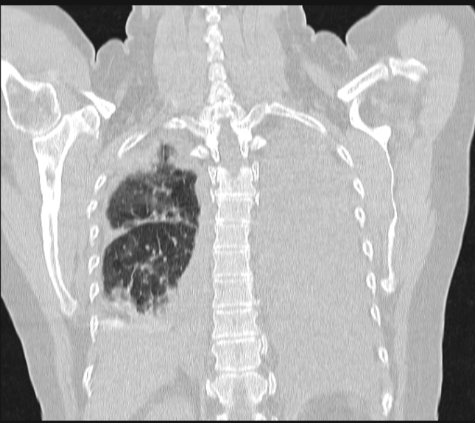 Boerhaave syndrome (Radiopaedia 45644-49799 Coronal lung window 53).jpg
