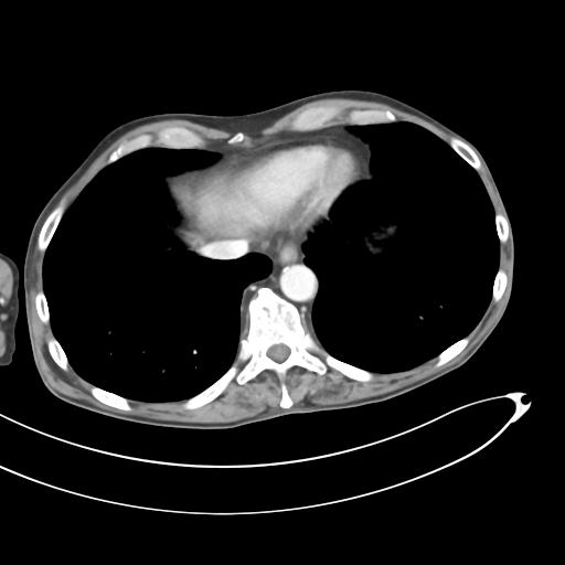 Bone metastasis from squamous cell carcinoma (Radiopaedia 30133-30730 B 8).jpg