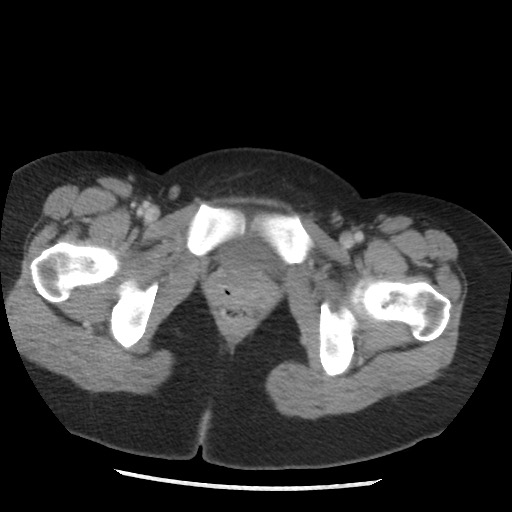 File:Borderline mucinous tumor (ovary) (Radiopaedia 78228-90808 A 139).jpg