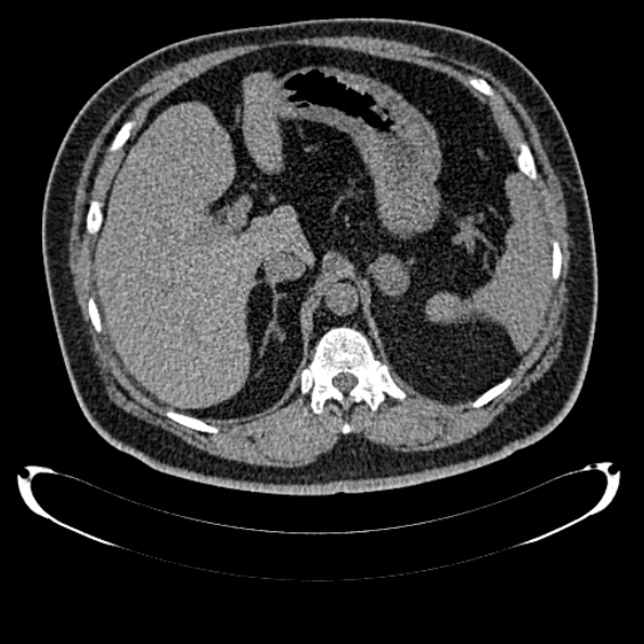 Bosniak renal cyst - type IV (Radiopaedia 24244-24518 Axial non-contrast 110).jpg