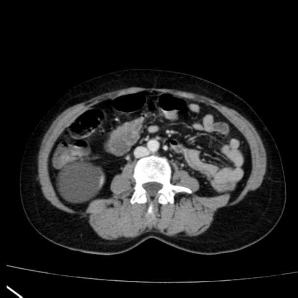 Bosniak renal cyst - type I (Radiopaedia 27479-27675 C 50).jpg
