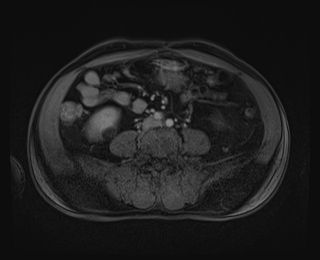 File:Bouveret syndrome (Radiopaedia 61017-68856 Axial T1 C+ fat sat 63).jpg
