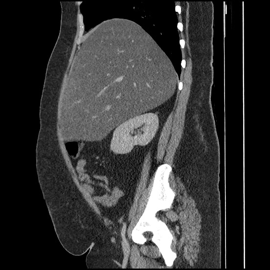 Bowel and splenic infarcts in acute lymphocytic leukemia (Radiopaedia 61055-68913 C 54).jpg