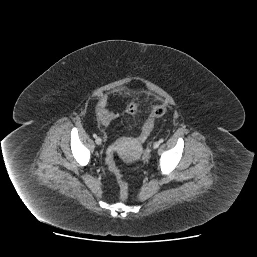 Bowel and splenic infarcts in acute lymphocytic leukemia (Radiopaedia 61055-68915 A 112).jpg
