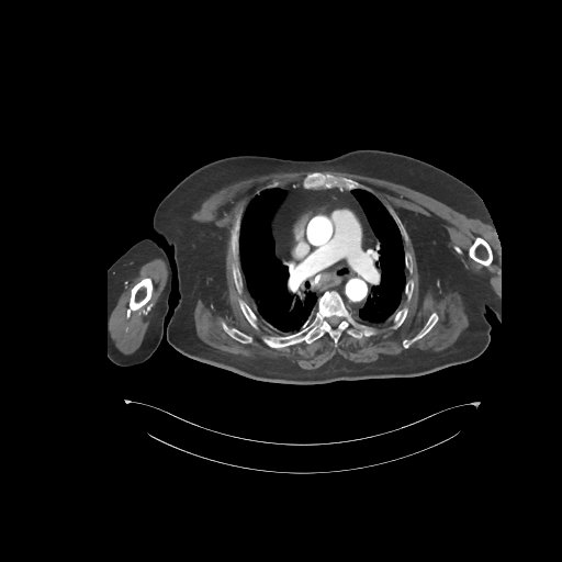 File:Bowel ischemia secondary to SMA occlusion with extensive portomesenteric venous gas (Radiopaedia 54656-60871 A 84).jpg